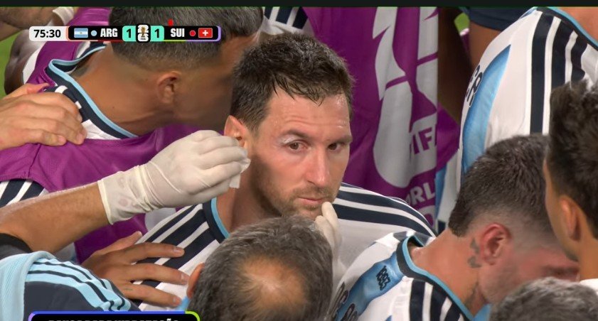 𩸠Messi bloodied above the eye, treated on the touchline 𪔠𩸠Messi bloodied above the eye, treated on the touchline šŖ”